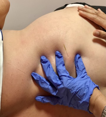 Dry Needling