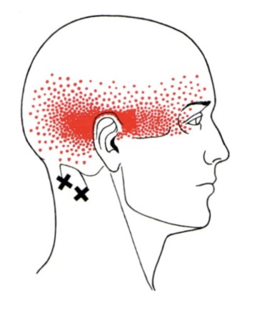 Triggerpunkt Therapie